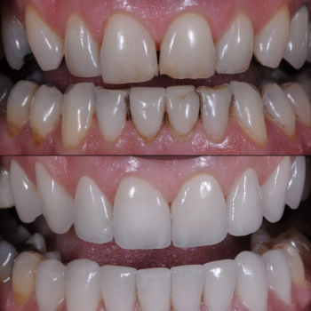 cosmetic-dentistry-nyc-before-and-after-photos-11