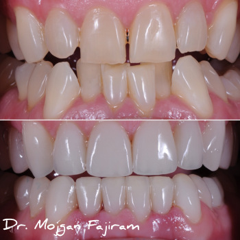 cosmetic-dentistry-nyc-before-and-after-photos-16