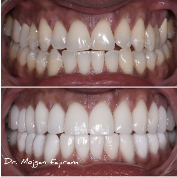 cosmetic-dentistry-nyc-before-and-after-photos-18