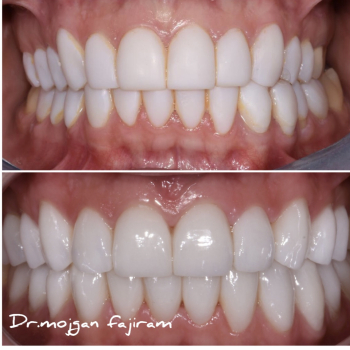 cosmetic-dentistry-nyc-before-and-after-photos-19