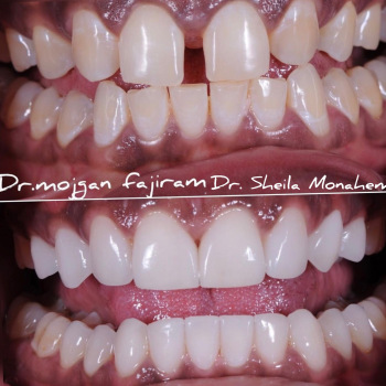 cosmetic-dentistry-nyc-before-and-after-photos-29