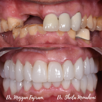 cosmetic-dentistry-nyc-before-and-after-photos-4