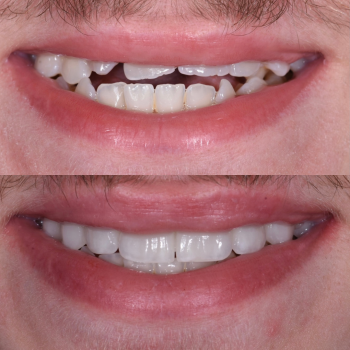 cosmetic-dentistry-nyc-before-and-after-photos-6