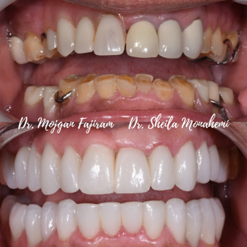 cosmetic-dentistry-nyc-before-and-after-photos-7
