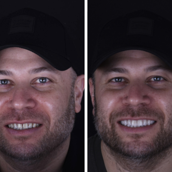 cosmetic-dentistry-nyc-before-and-after-photos-81
