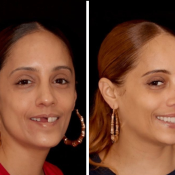 cosmetic-dentistry-nyc-before-and-after-photos-811