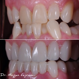 cosmetic-dentistry-nyc-before-and-after-photos-17