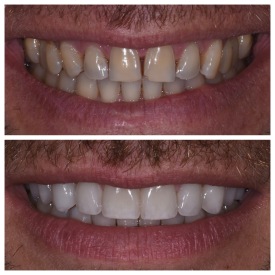 cosmetic-dentistry-nyc-before-and-after-photos-26