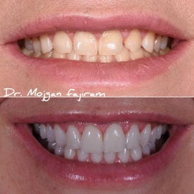 cosmetic-dentistry-nyc-before-and-after-photos-27