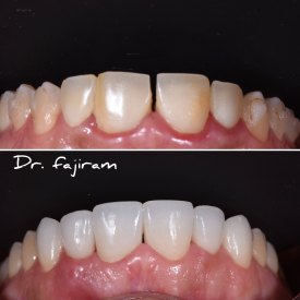 cosmetic-dentistry-nyc-before-and-after-photos-28