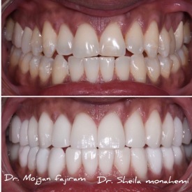 cosmetic-dentistry-nyc-before-and-after-photos-30