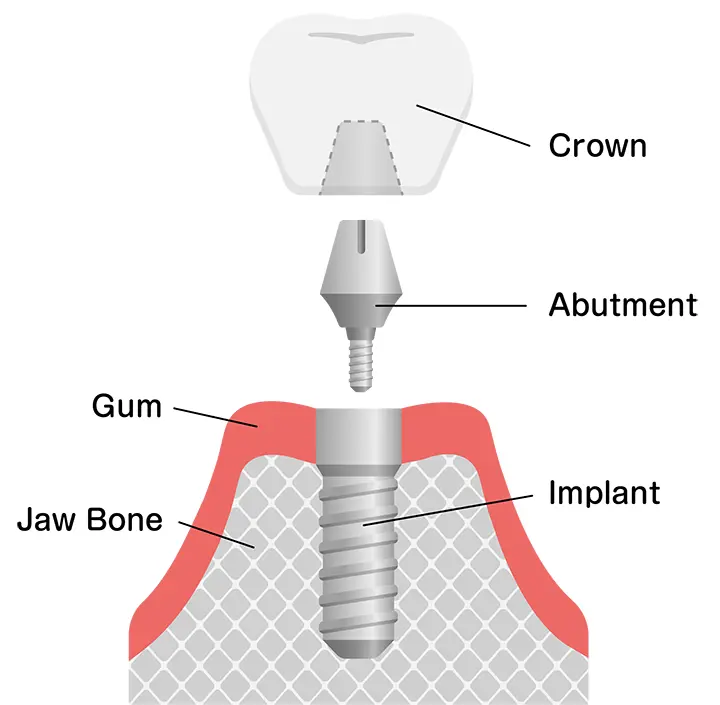 Dental implants schema