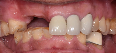 Full Mouth Reconstruction Case 1 before