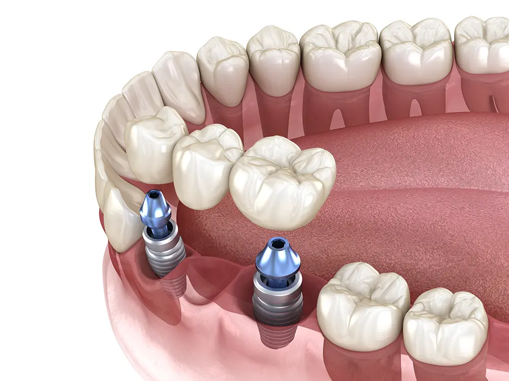 Upon Dental Implants